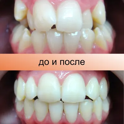 Соска влияет на прикус? Короткую уздечку нужно оперировать? Готическое небо  – это поправимо? Стенограмма прямого эфира со стоматологом-ортодонтом  Елизаветой Целовальник — Благотворительный фонд помощи недоношенным детям  «Право на чудо»