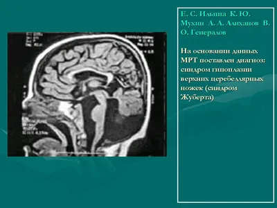 Короткая уздечка. Подрезать или нет? | Логопед-дефектолог | Дзен