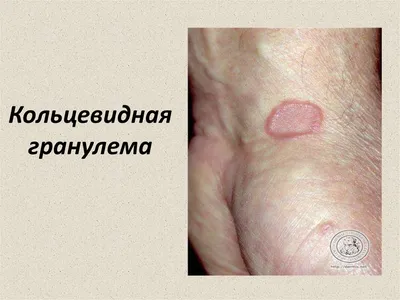 Лечение пиогенной гранулемы лазером в Кирове в клинике Возрождение