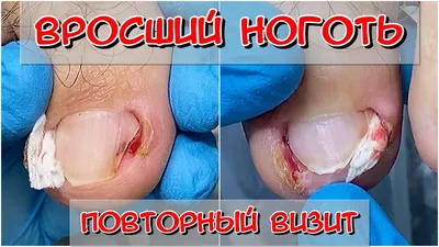 Псориаз ногтей — Derma.ua