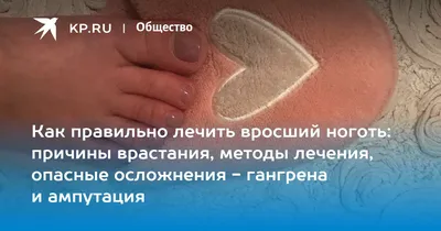 Радиоволновое удаление вросшего ногтя на Юго-Западе. Теплый стан, Ясенево,  Коньково, Беляево ЮЗАО