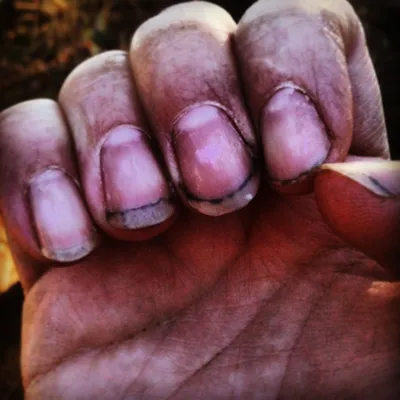 грязные ногти могут вызвать серьезные заразные болезни неполный маникюр для  фона. длинные ногти всегда должны поддерживаться Стоковое Фото -  изображение насчитывающей влажно, изолировано: 228158468