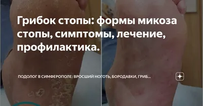 Грибок ногтей у детей: причины и лечение ✓ Клиника подологии Полёт в Москве