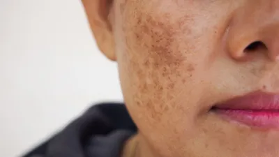 Мазь Король кожи -китайская лечебная мазь от дермозаболеваний кожи, таких  как: лишай, чесотка, акне, грибок, ногтевой грибок, псориаз… | Instagram