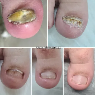 Грибок ногтей: опасность лечения