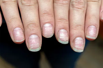 Онихомикоз или грибок ногтей - Життя без болю (Zdorovaya Stopa)