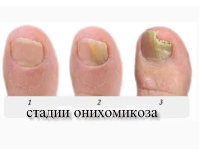 Симптомы онихомикоза — грибка ногтей |