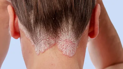 Грибковые заболевания кожи » Клиника косметологии и дерматологии «ACADEMY»  — лечение кожи и волос.