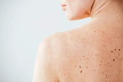 Грибок кожи: диагностика, лечение, препараты и мази