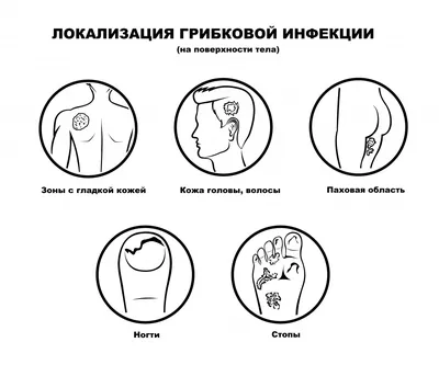 Лечение микоза кожи в Киеве. Лечение грибка кожи рук, ног и др. частей тела  в клинике Бреннера.
