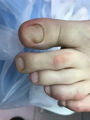 Студии подологии и педикюра Medped - Здоровые ногтевые пластины розового  оттенка с легким блеском и гладкой поверхностью. Нередко ногти на руках и  ногах желтеют. Многие увидев у себя желтые ногти, сразу думают,