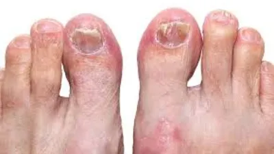 Причины появления желтых ногтей на ногах и способы их устранения