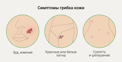 Лечение грибковых заболеваний кожи в Алматы - Лечение псориаза и витилиго в  Алматы.