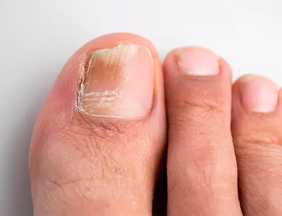 Грибковые заболевания кожи и ногтей относятся к группе инфекционных  заболеваний человека, которые вызываются болезнетворными грибами. ⠀ По … |  Instagram