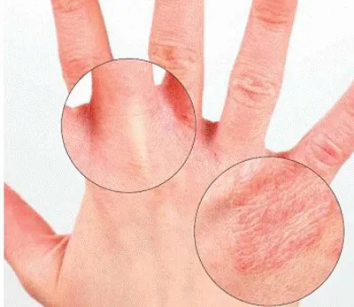 Грибковая инфекция ногтей и кожи: симптомы, признаки и лечение грибковой  инфекции