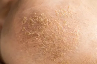 Микоз гладкой кожи - что это такое, лечение грибкового заболевания,  симптомы, сколько лечится грибок на теле, виды и как передается  микотическое поражение