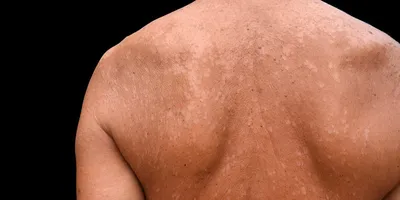 Опыт лечения неосложненной микроспории гладкой кожи препаратом Ламизил 1%  спрей uMEDp