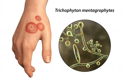 Грибок на коже и ногтях у детей: причины, симптомы и лечение грибковых  заболеваний