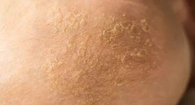 Инфекция кандиды на человеческой коже Стоковое Изображение - изображение  насчитывающей макрос, грибково: 94578157