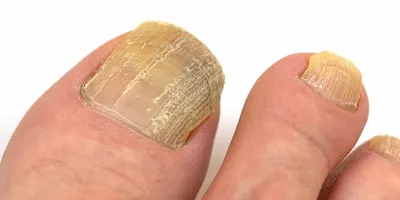 Грибок кожи, ногтей, складок | Центр подологии и остеопатии Татьяны Красюк