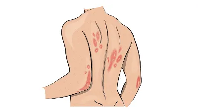 Лечение грибка кожи: как избавиться и чем лечить грибок кожи?