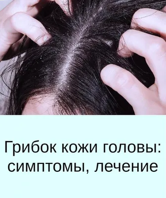 Псориаз волосистой части головы. Симптомы | МЦ Данимед