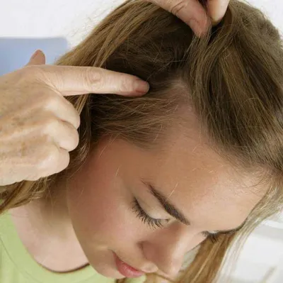 Как избавиться от перхоти, вызванной грибком кожи головы: эффективный  шампунь от сухой перхоти для лечения кожи головы
