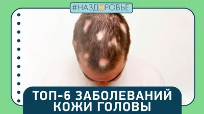 Грибок кожи головы - Вопрос дерматологу - 03 Онлайн
