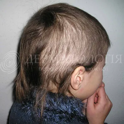 Фурункулез волосистой части головы симптомы и лечение