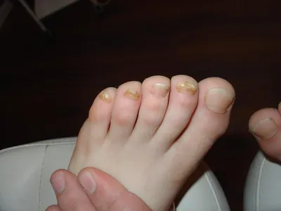 15 г ZB Крем для лечения кожи ног, лечение запаха ног, Tinea pegis,  анти-зуд, подавляет грибок, уход за ногами, медицинская мазь | AliExpress