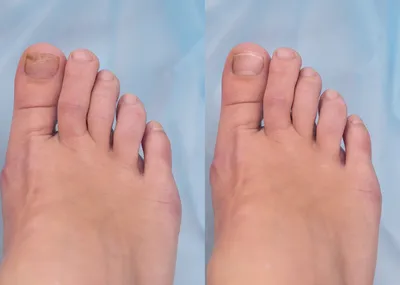 Чем вылечить грибок ноги стопы ногтей пальцев - YouTube