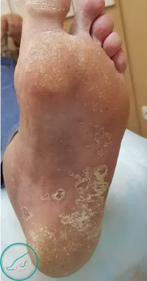 Эко-Педикюр - Грибок кожи ног является распространенным заболеванием в  настоящее время. Микоз - это инфекционное заболевание, которое поражает  кожный покров и ногтевые пластины. Грибковое заражение кожного покрова  указывает на снижение иммунной системы.