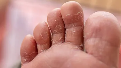 Удаление и лечение грибка ногтей лазером на ногах и руках в  Санкт-Петербурге в клинике Medclub: цены и отзывы пациентов.