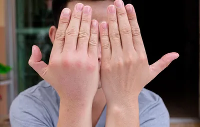 Опухший сустав пальца руки: причины, диагностика и методы лечения