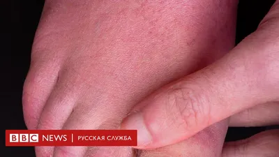 Коронавирус: откуда берутся \"ковидные пальцы\"? - BBC News Русская служба