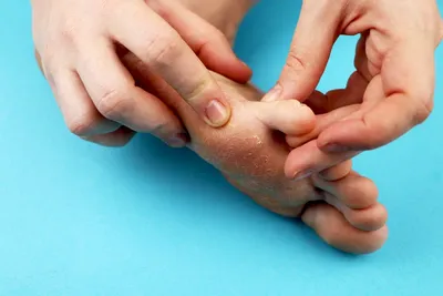 Как лечить грибок ногтей - Coolaser Clinic