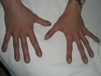 Грибок стопы (микоз стоп): лечение в Москве | Лечение микоза ногтей на руках  и ногах в Клинике подологии Полёт