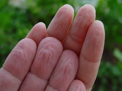 Аллергия у мастера маникюра на гель-лак, ногтевую пыль, перчатки.  Профилактика и лечение