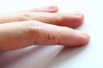 Трещины на пальцах рук: как избавиться от проблемы? | Новости Одессы