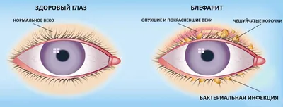 Грибковый блефарит — симптомы - энциклопедия Ochkov.net