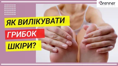 Лечение грибка ногтей лазером без боли, терапия онихомикоза в Киеве