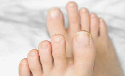 Лечение онихомикоза ногтей — лечение грибка ногтей в Красноярске