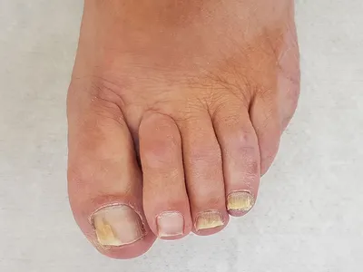Грибок на пальцах ног - причины, симптомы, лечение микоза.
