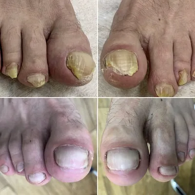 Как вылечить грибок ногтей на ногах и руках - симптомы, советы
