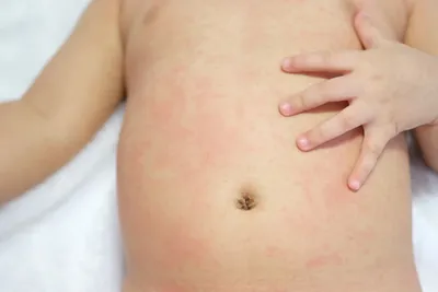 Атопический дерматит у ребенка: причины, симптомы и лечение | Клиника  «Семейный доктор»