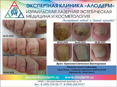 Лечение грибка на ногтях ног фото до и после | Клиника АЛОДЕРМ , Москва