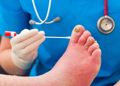 Лечение и диагностика грибка ногтей: средства, способы, методы терапии  онихомикоза