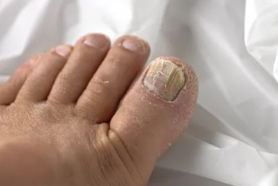 Лечение запущенной формы грибка ногтей, признаки застарелого онихомикоза