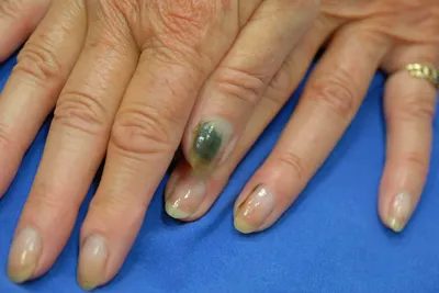 Клинические различия псориаза ногтей и грибка ногтей ✓ Авторские статьи  Клиники подологии Полёт в Москве
