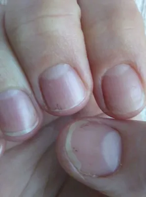 Черные полоски под ногтями: возможные причины и методы лечения